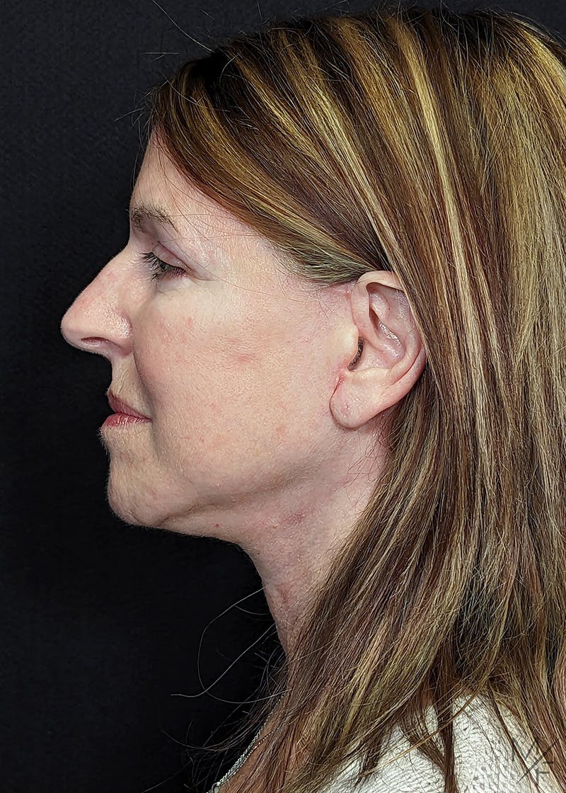 Facelift Before & After Gallery - Patient 148864625 - Image 6