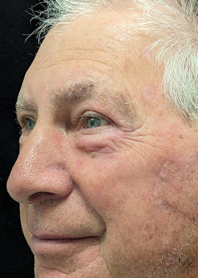 Skin Cancer Reconstruction Before & After Gallery - Patient 149236559 - Image 2