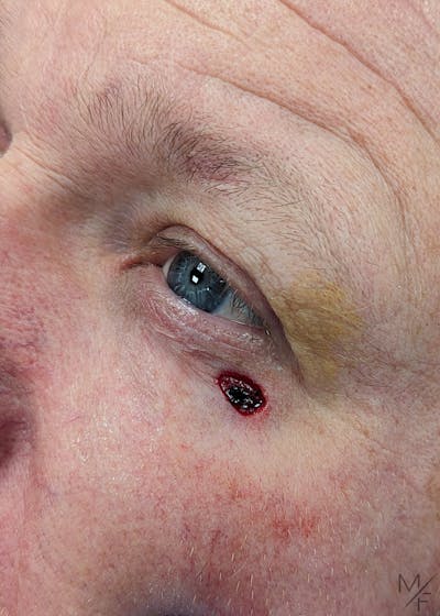 Skin Cancer Reconstruction Before & After Gallery - Patient 149236560 - Image 1