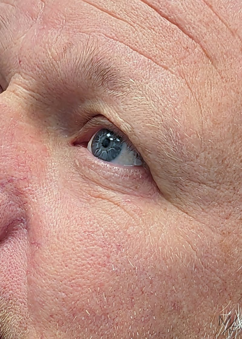 Skin Cancer Reconstruction Before & After Gallery - Patient 149236560 - Image 2