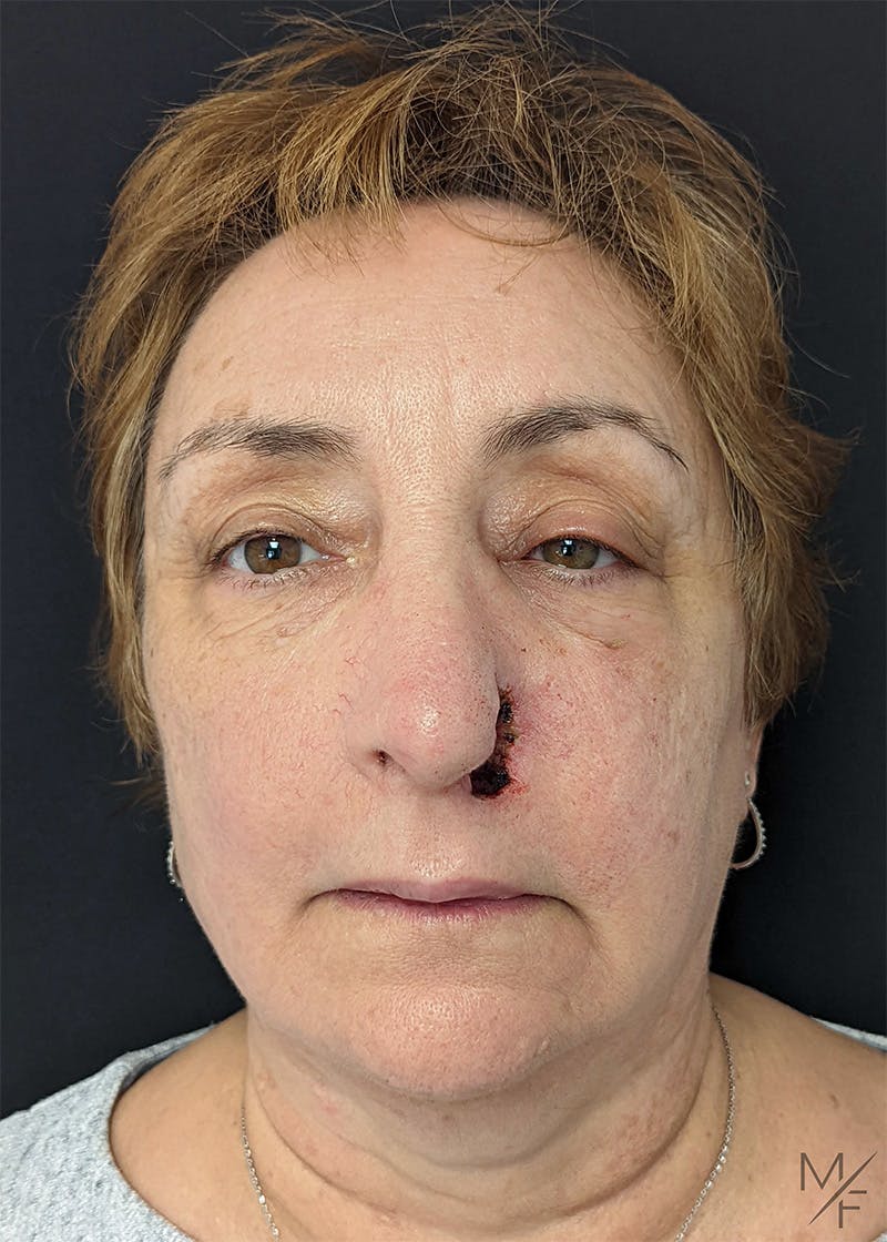 Skin Cancer Reconstruction Before & After Gallery - Patient 154771914 - Image 1