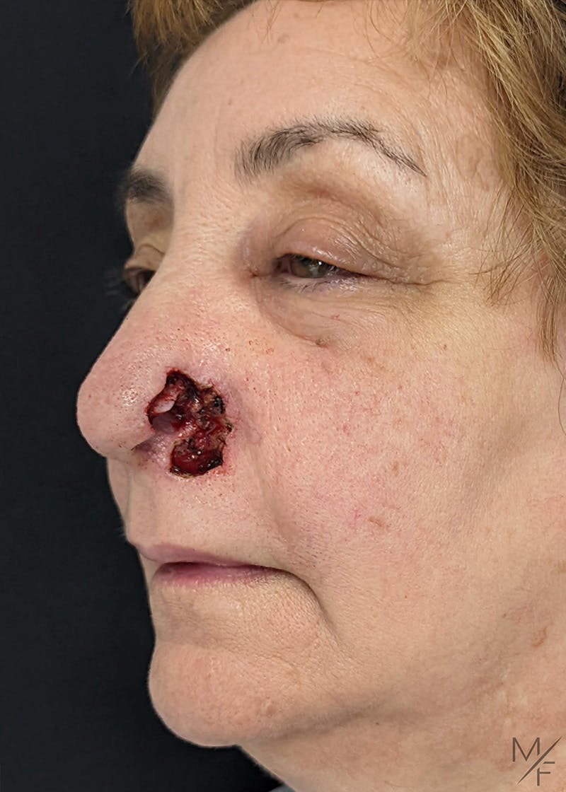 Skin Cancer Reconstruction Before & After Gallery - Patient 154771914 - Image 3
