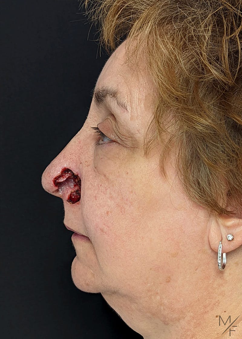 Skin Cancer Reconstruction Before & After Gallery - Patient 154771914 - Image 5