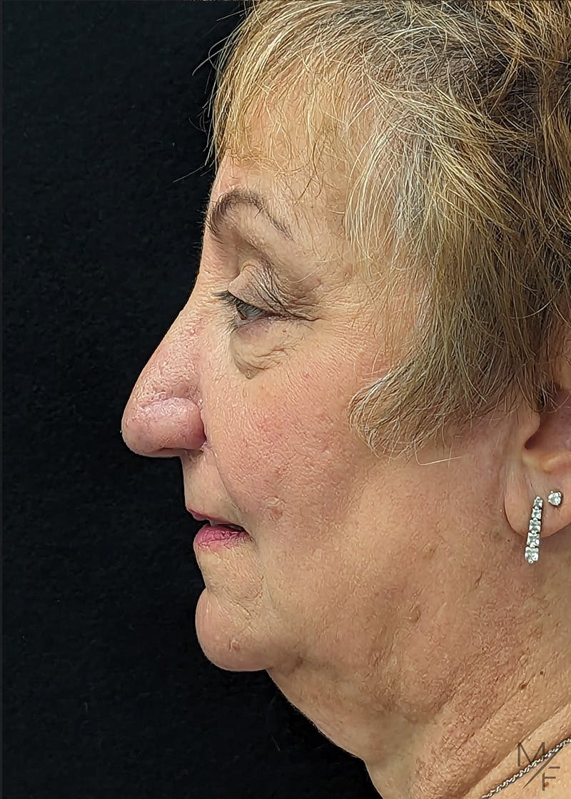 Skin Cancer Reconstruction Before & After Gallery - Patient 154771914 - Image 6