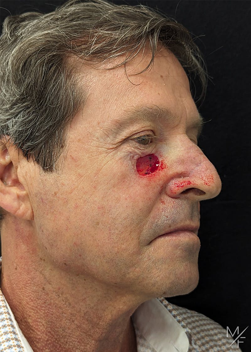Skin Cancer Reconstruction Before & After Gallery - Patient 179508996 - Image 1