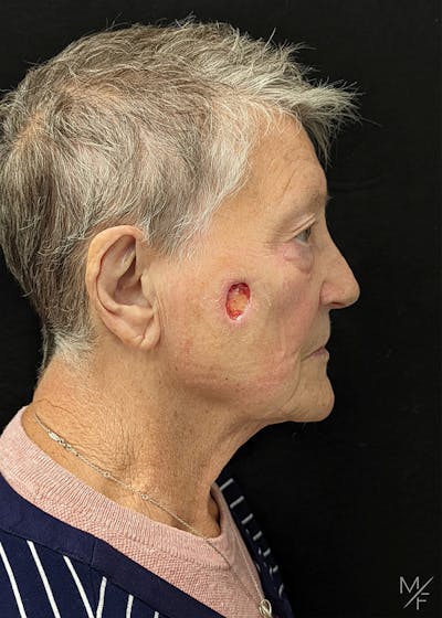 Skin Cancer Reconstruction Before & After Gallery - Patient 179509035 - Image 1