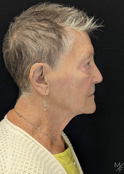 Skin Cancer Reconstruction Before & After Gallery - Patient 179509035 - Image 2
