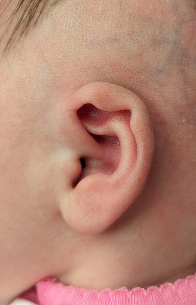 Ear Molding Before & After Gallery - Patient 179749042 - Image 1
