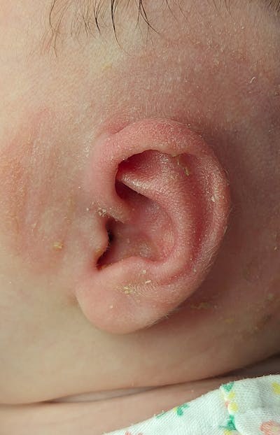 Ear Molding Before & After Gallery - Patient 179749042 - Image 2