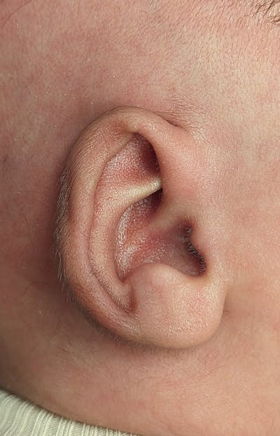 Ear Molding Before & After Gallery - Patient 179749041 - Image 1