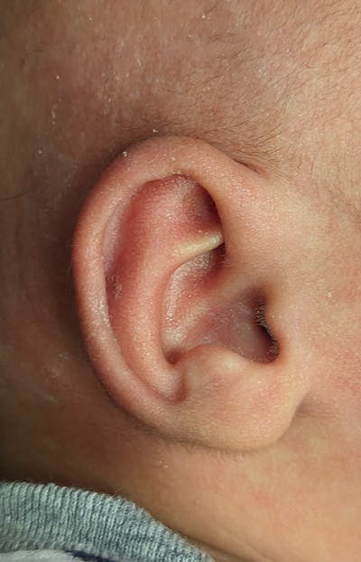 Ear Molding Before & After Gallery - Patient 179749041 - Image 2