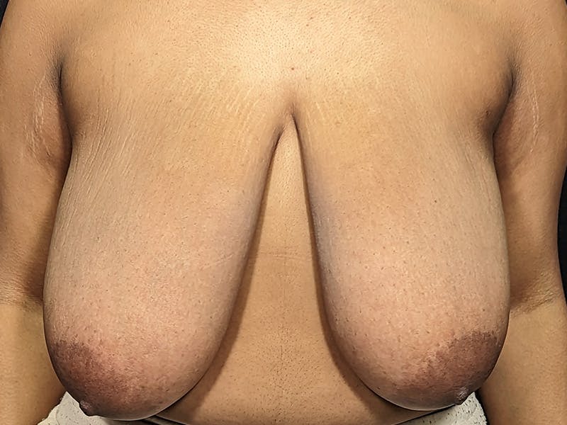 Breast Reduction Before & After Gallery - Patient 311289 - Image 1