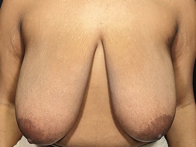 Breast Reduction Before & After Gallery - Patient 311289 - Image 1