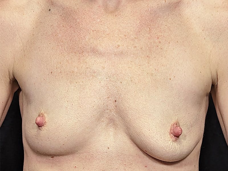 Breast Augmentation Before & After Gallery - Patient 211616 - Image 1