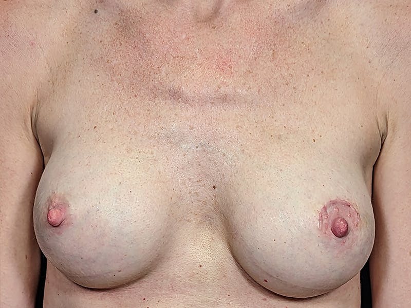 Breast Augmentation Before & After Gallery - Patient 211616 - Image 2