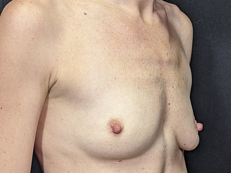 Breast Augmentation Before & After Gallery - Patient 211616 - Image 3