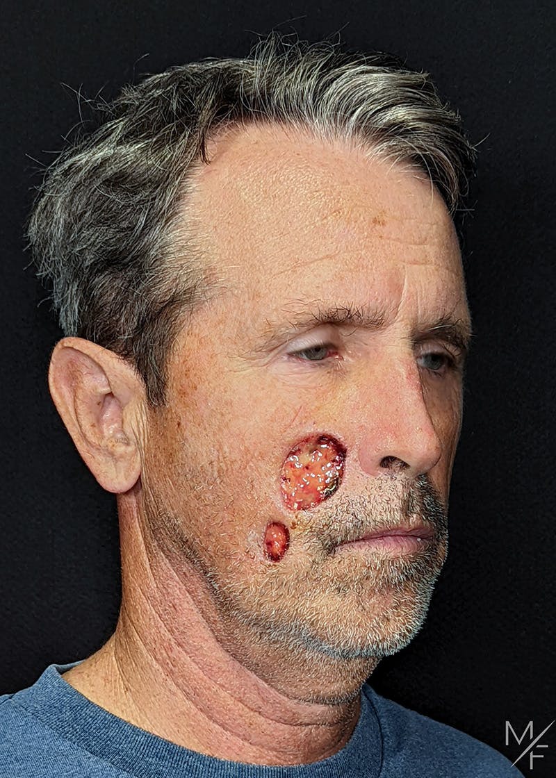 Skin Cancer Reconstruction Before & After Gallery - Patient 103924 - Image 1