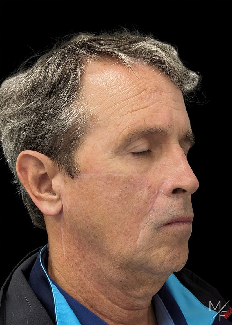 Skin Cancer Reconstruction Before & After Gallery - Patient 103924 - Image 2