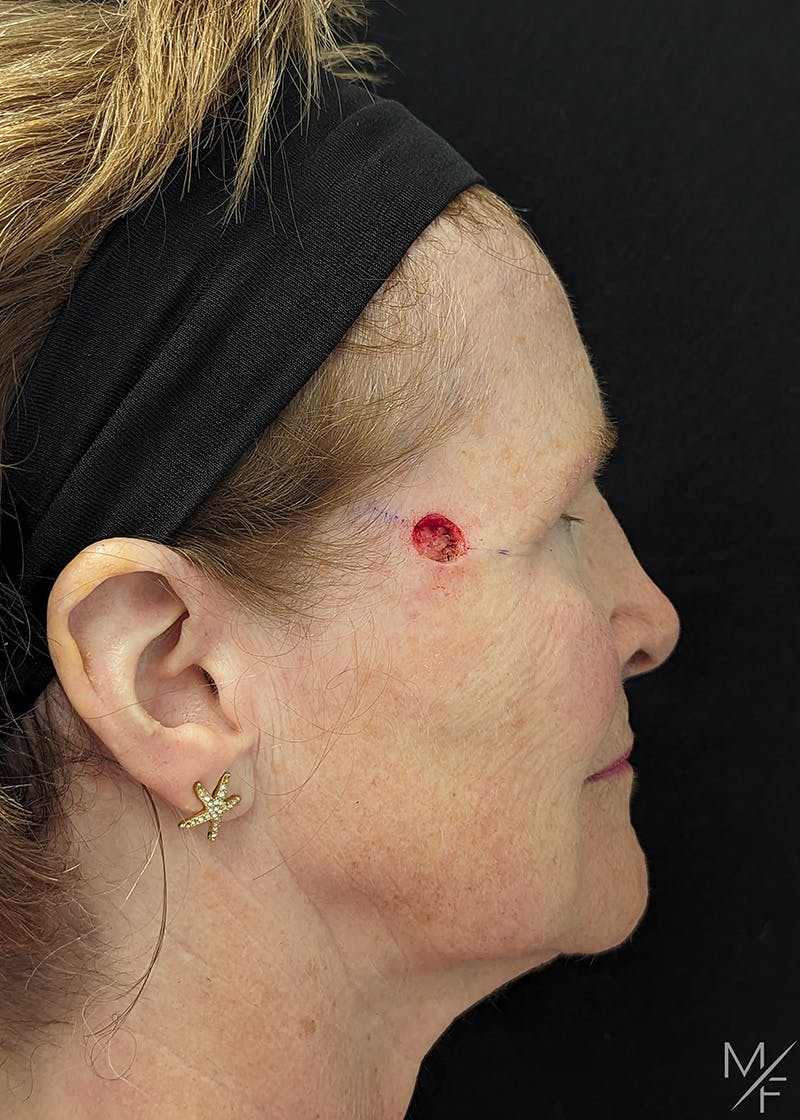 Skin Cancer Reconstruction Before & After Gallery - Patient 357339 - Image 1