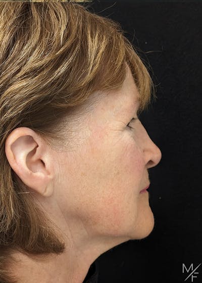 Skin Cancer Reconstruction Before & After Gallery - Patient 357339 - Image 2