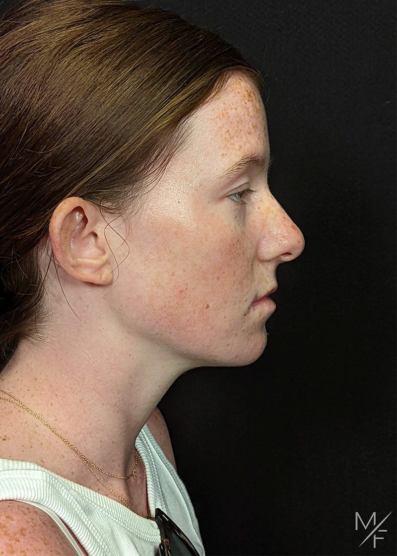 Rhinoplasty Before & After Gallery - Patient 242354 - Image 1