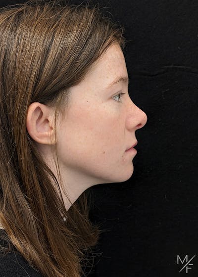 Rhinoplasty Before & After Gallery - Patient 242354 - Image 2