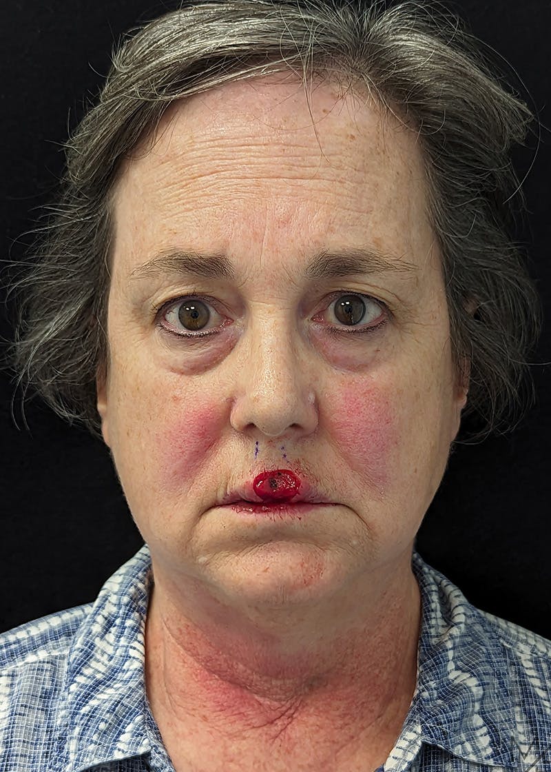 Skin Cancer Reconstruction Before & After Gallery - Patient 110229 - Image 1