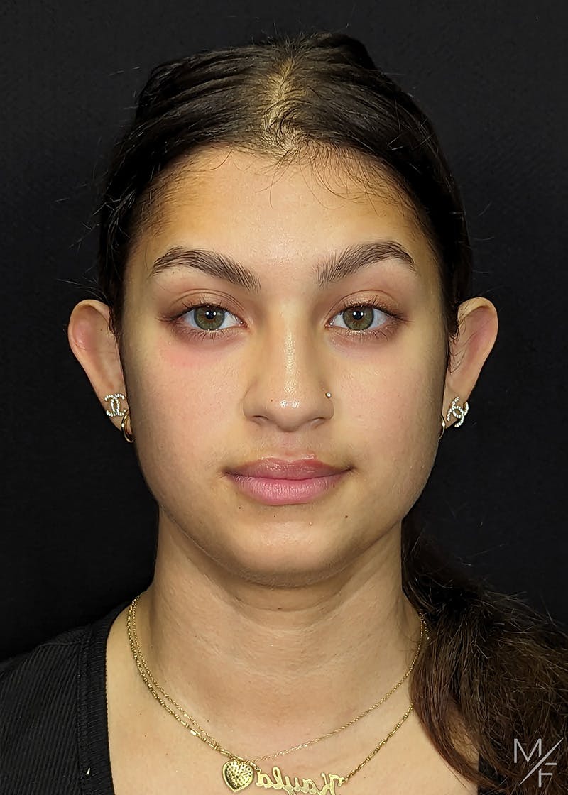 Otoplasty Before & After Gallery - Patient 170792 - Image 1