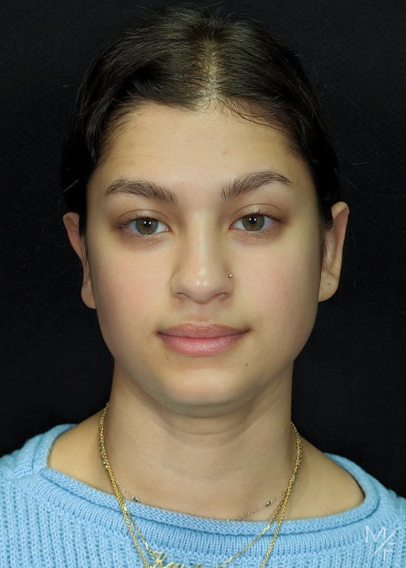 Otoplasty Before & After Gallery - Patient 170792 - Image 2