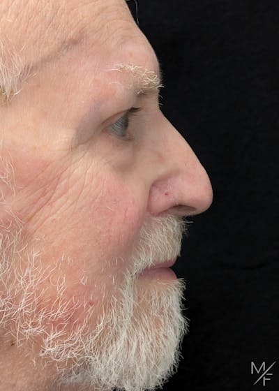 Skin Cancer Reconstruction Before & After Gallery - Patient 158790 - Image 2