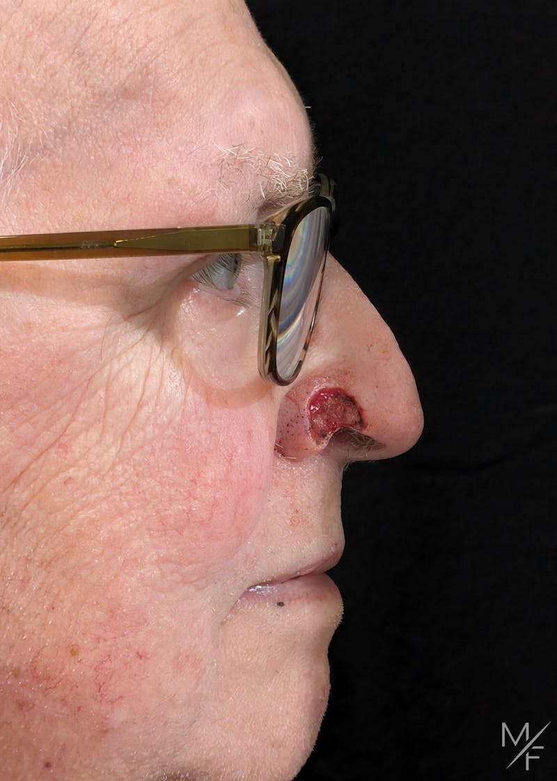 Skin Cancer Reconstruction Before & After Gallery - Patient 158790 - Image 1