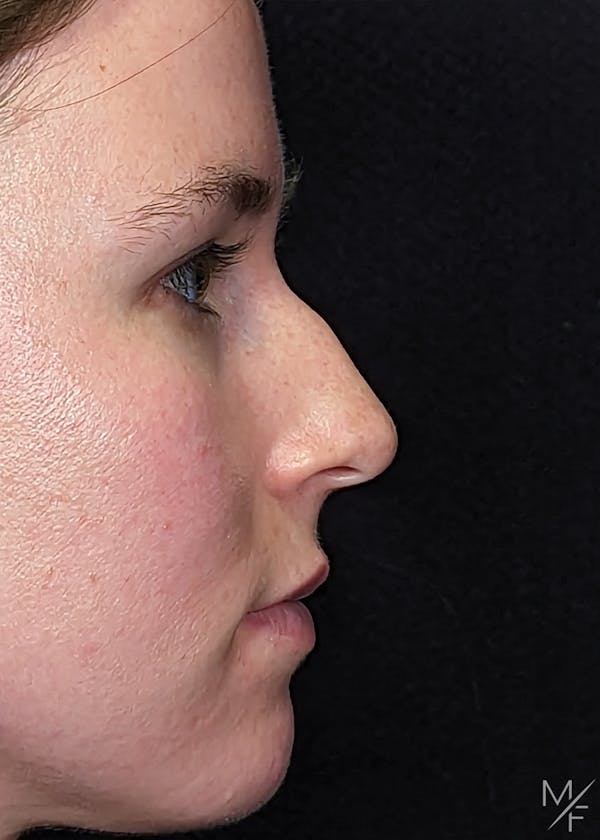 Rhinoplasty