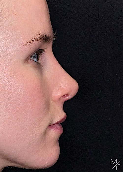 Rhinoplasty