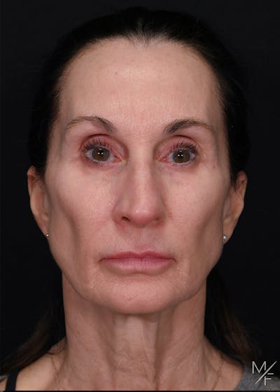 Facelift Before & After Gallery - Patient 887056 - Image 1