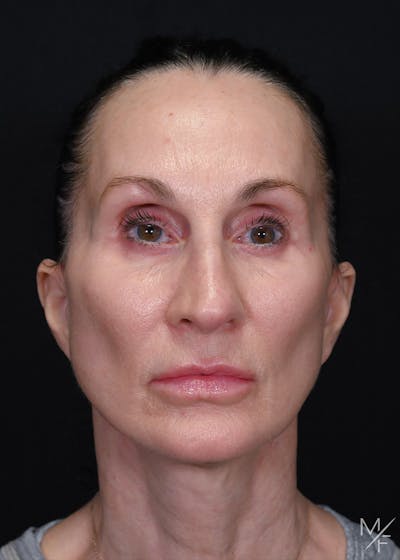 Facelift Before & After Gallery - Patient 887056 - Image 2