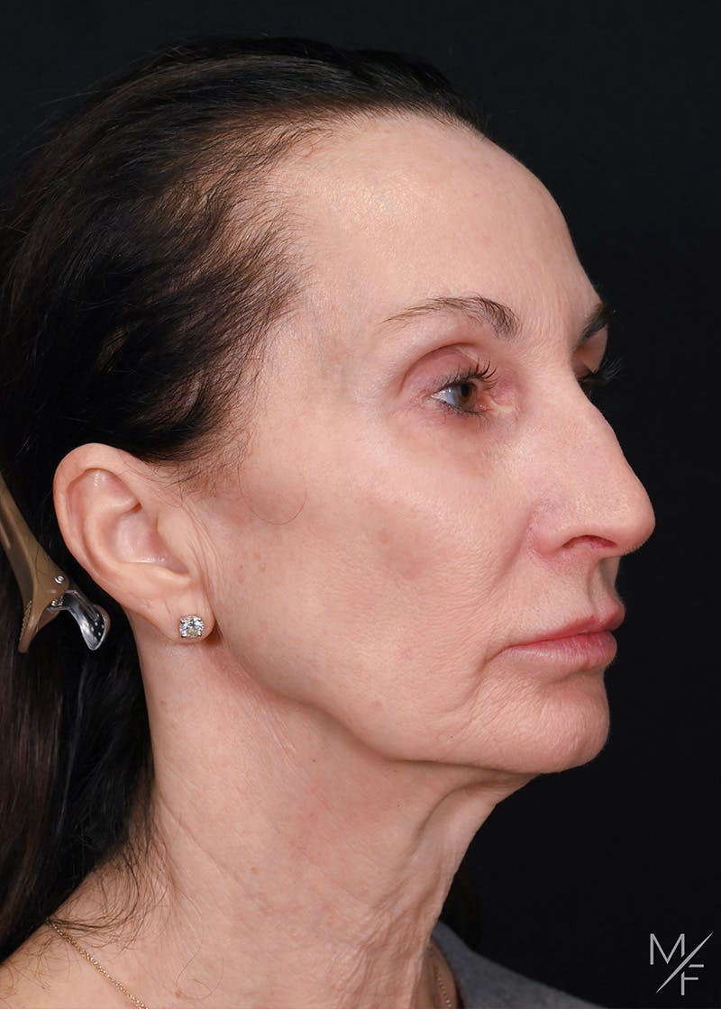 Facelift Before & After Gallery - Patient 887056 - Image 3
