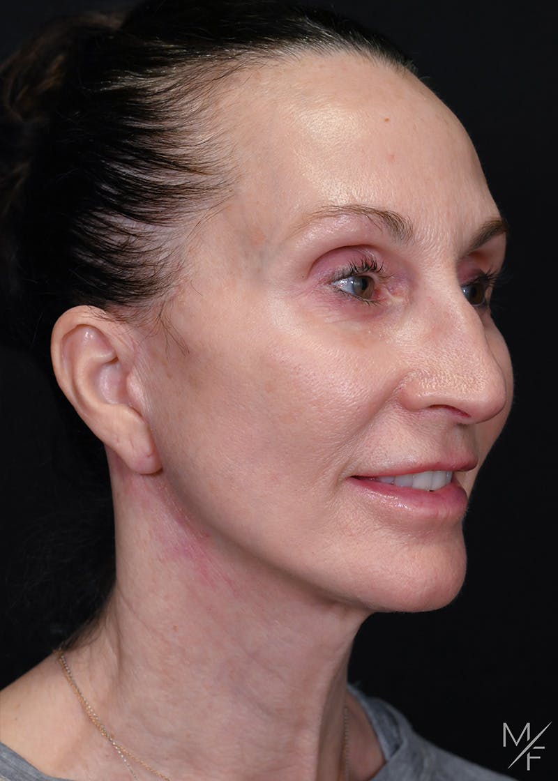 Facelift Before & After Gallery - Patient 887056 - Image 4