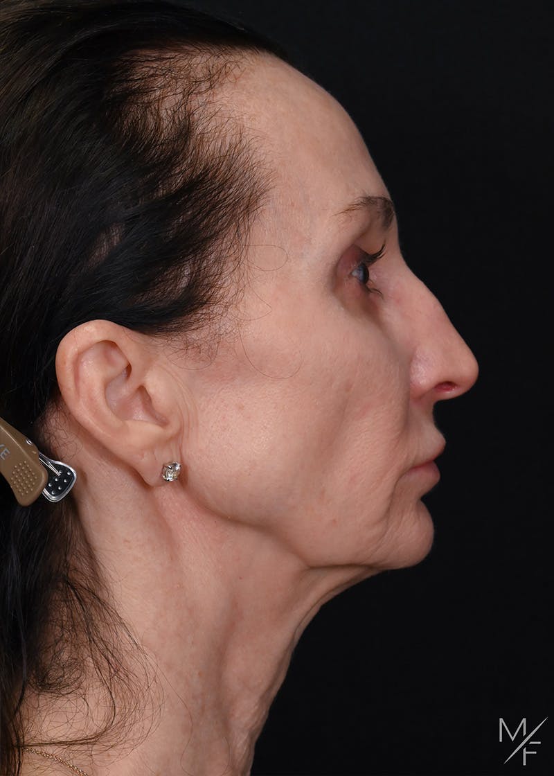 Facelift Before & After Gallery - Patient 887056 - Image 5