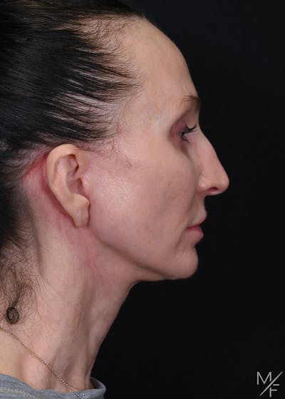 Neck Lift Before & After Gallery - Patient 417154 - Image 2