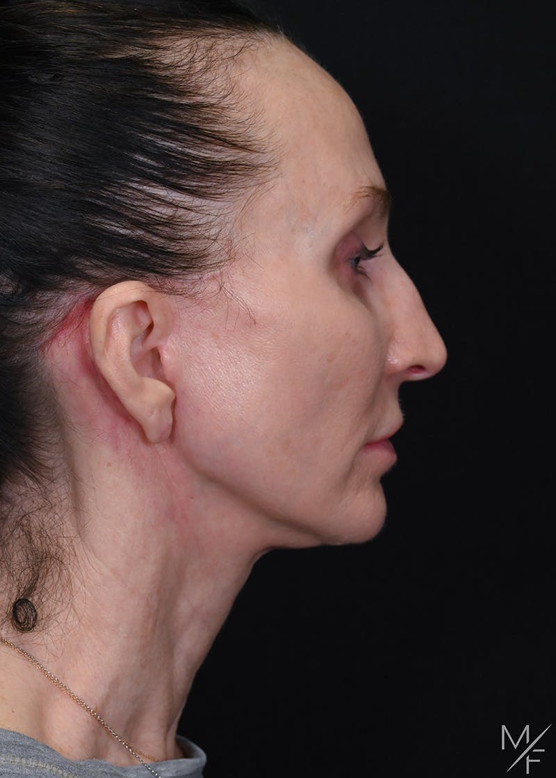 Facelift Before & After Gallery - Patient 887056 - Image 6