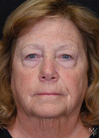 Blepharoplasty Before & After Gallery - Patient 202589 - Image 1