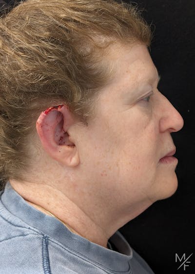 Skin Cancer Reconstruction Before & After Gallery - Patient 337844 - Image 1