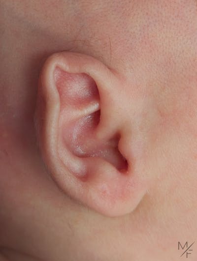 Ear Molding Before & After Gallery - Patient 167061 - Image 1