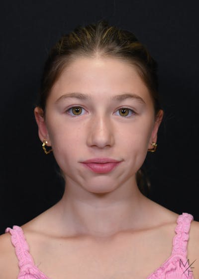 Otoplasty Before & After Gallery - Patient 634583 - Image 2