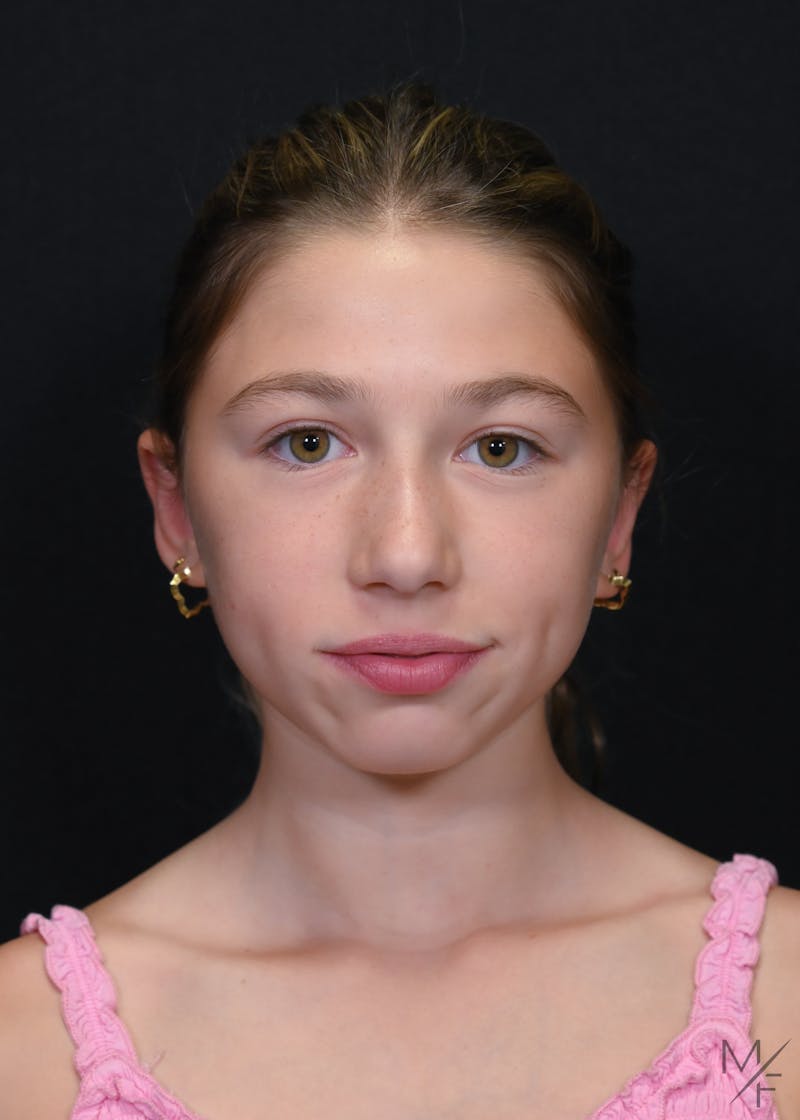Otoplasty Before & After Gallery - Patient 634583 - Image 2