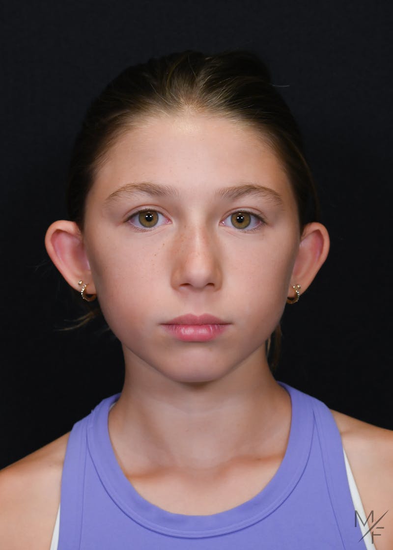 Otoplasty Before & After Gallery - Patient 634583 - Image 1