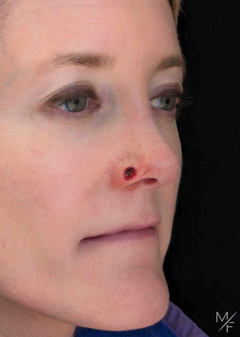 Skin Cancer Reconstruction Before & After Gallery - Patient 401465 - Image 1