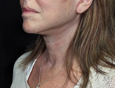 Facelift Before & After Gallery - Patient 148864625 - Image 2