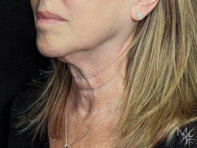 Facelift Before & After Gallery - Patient 148864625 - Image 1