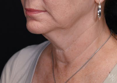 Facelift Before & After Gallery - Patient 370603 - Image 1
